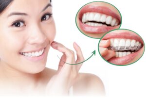 Foto pessoa alinhadores de dente